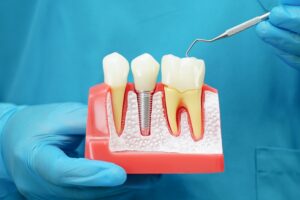 Dental Implants Danville